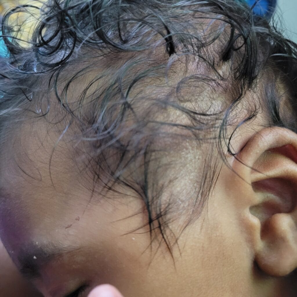 Close-up of a baby’s scalp with cradle cap dryness on the side of the head.