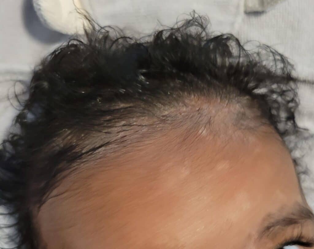 A close up of a baby with cradle cap on his crown