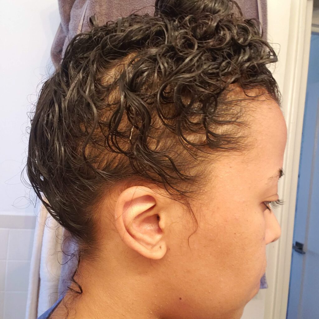 Side profile showing visible thinning and patchy hair loss near the temple, dated around August 2020.