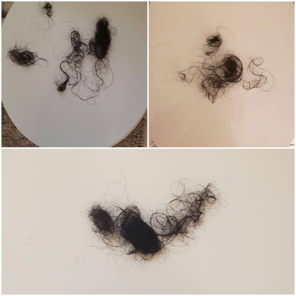 Collage of four photos displaying clumps of shed hair on a white surface, documenting the extent of hair loss.