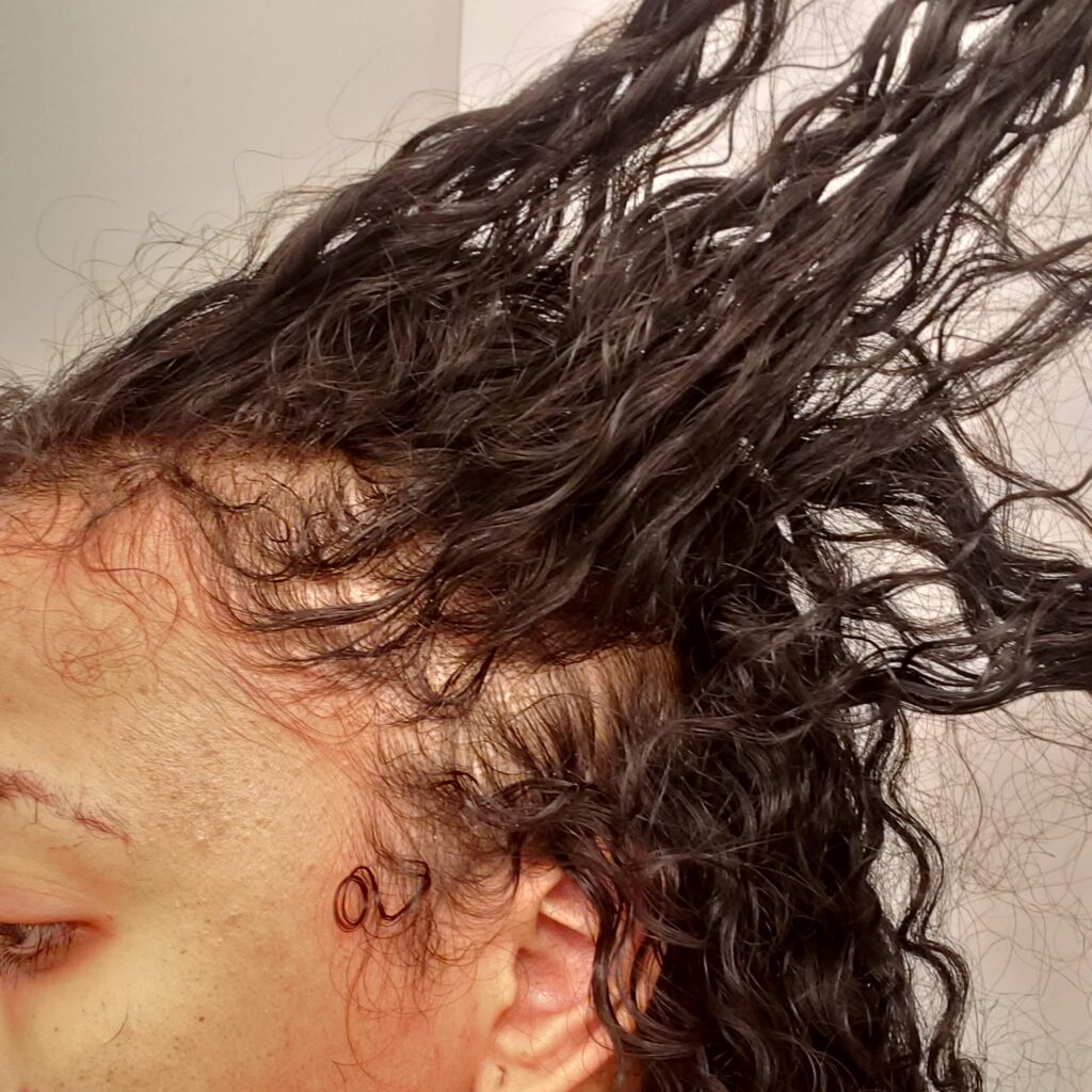 Side view of scalp with significant hair thinning and shedding, captured in December during worsening hair loss.