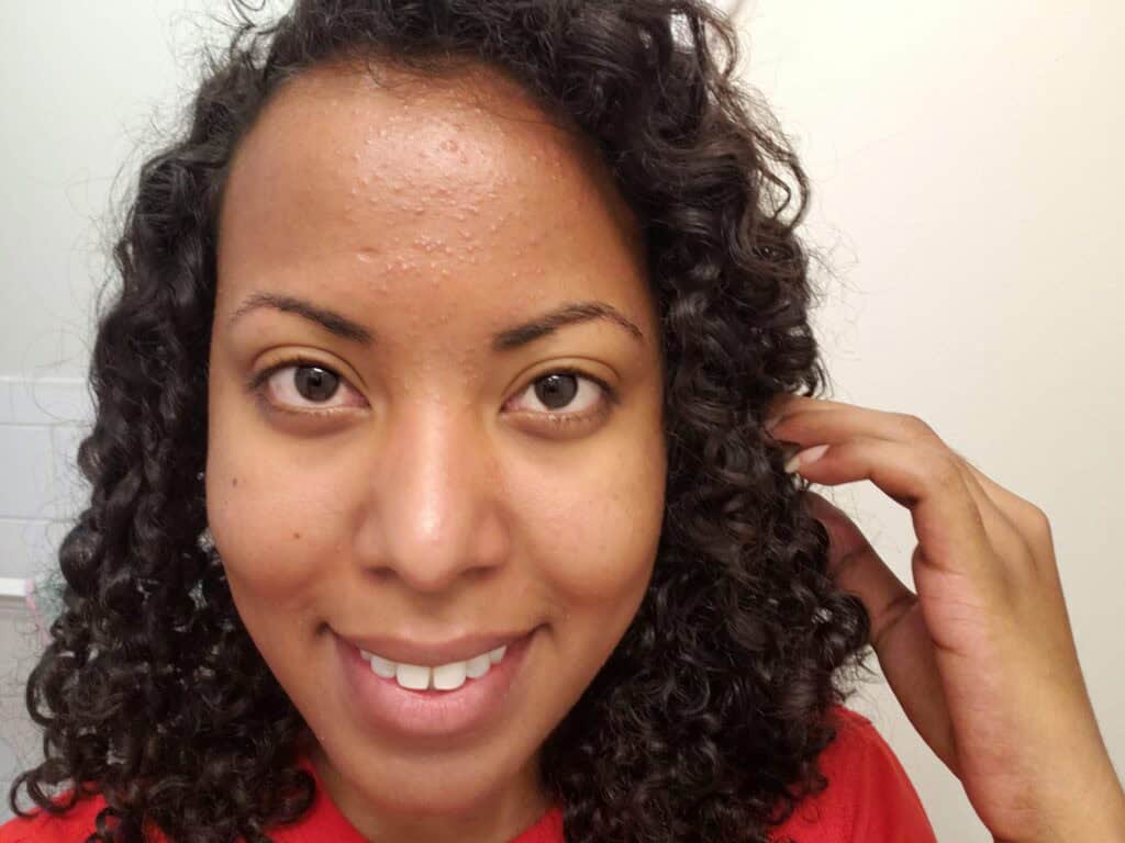 Selfie from 2019 showing minor acne and texture during my skincare journey