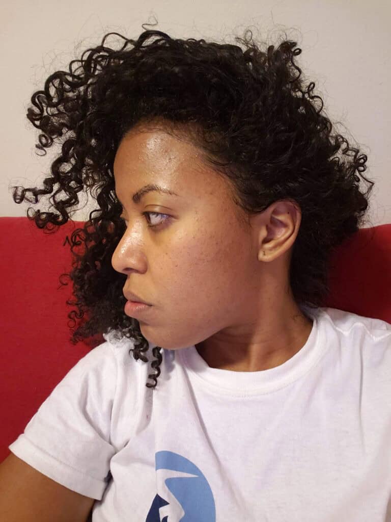 Side profile of my skin in 2019 with small breakouts along the hairline and jawline.