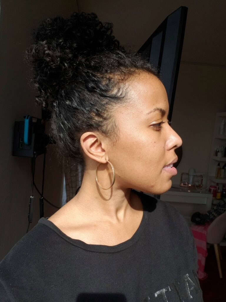 March 2020 side profile photo showing cleared skin and smooth texture after consistent acne treatments.
