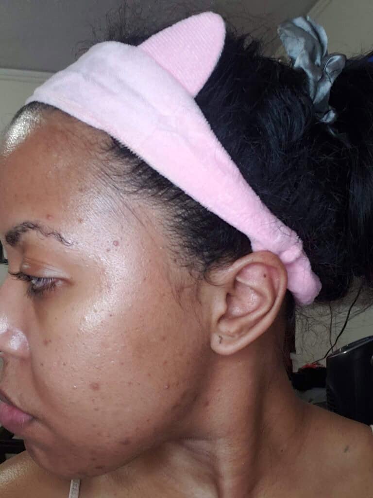 Side profile showing acne breakouts and hyperpigmentation on cheek.
