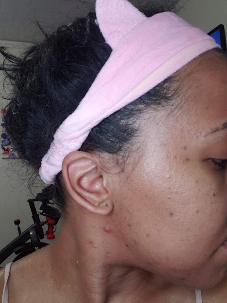 Skin with visible cystic acne and redness along jawline.