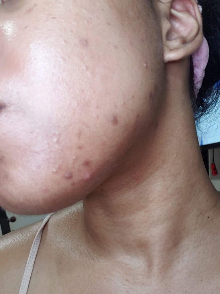 Close-up of cheek with inflamed acne and post-acne marks before treatment.