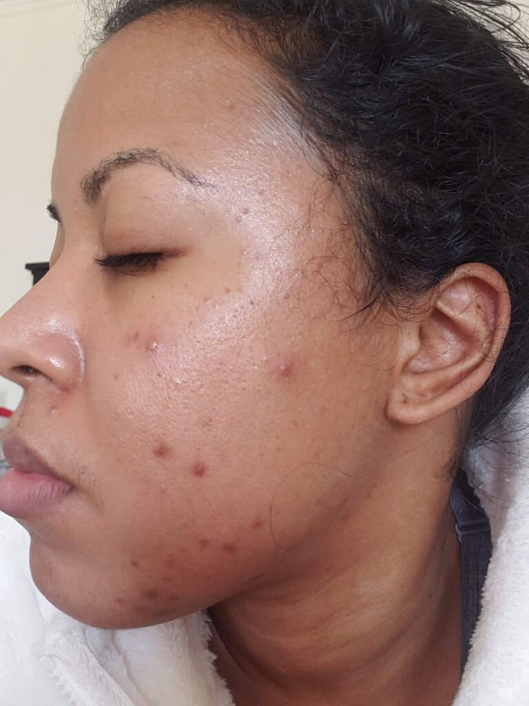 Cheek and jawline with multiple dark spots and acne scars.