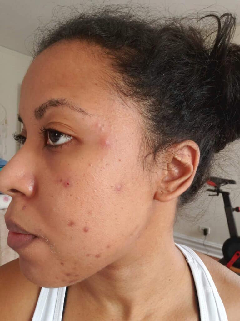 Side profile of acne scars and active breakouts before skincare treatments.