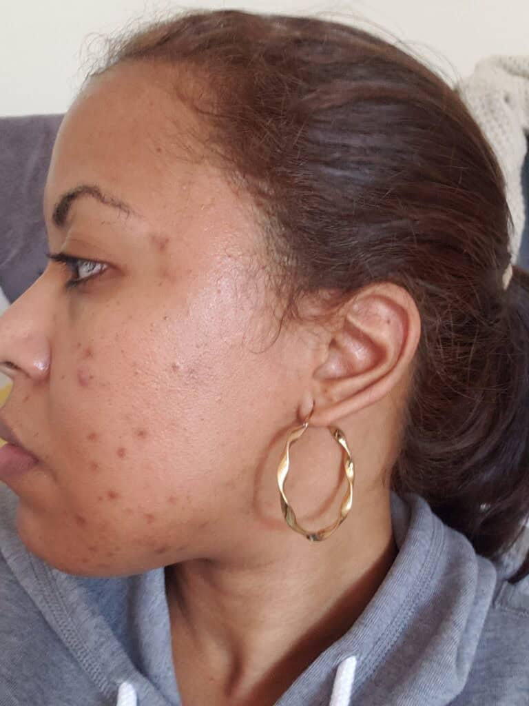 Side view with hyperpigmentation, acne scars, and textured skin.