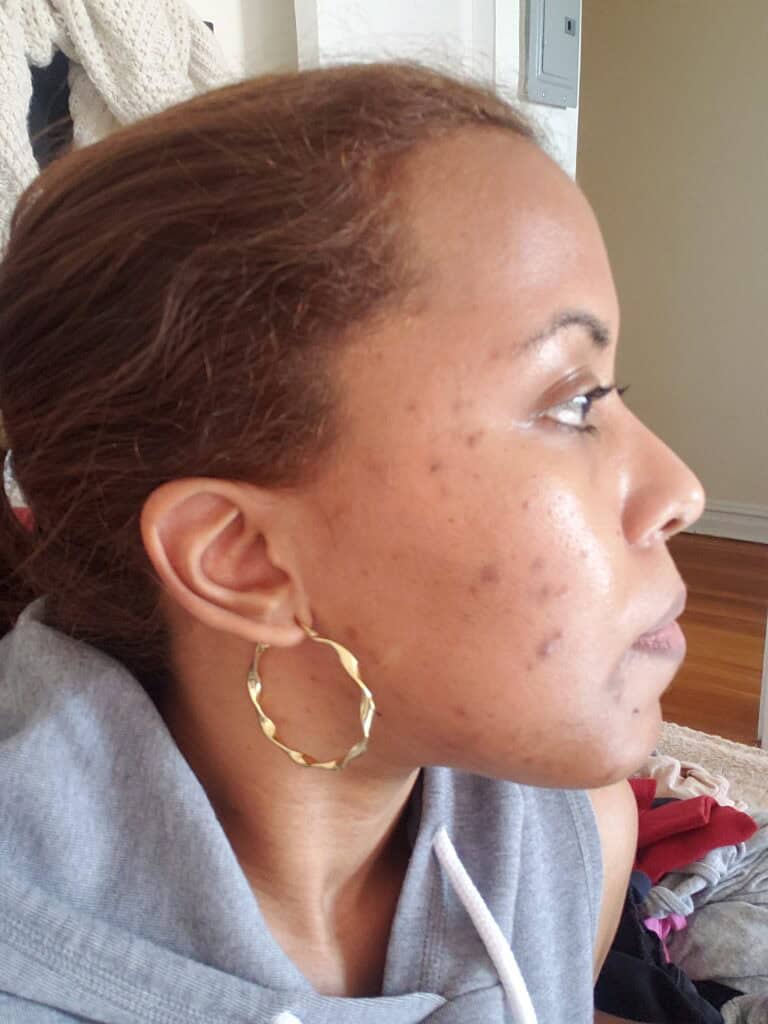 Close-up of cheek showing acne scars and discoloration before Hydrafacial.