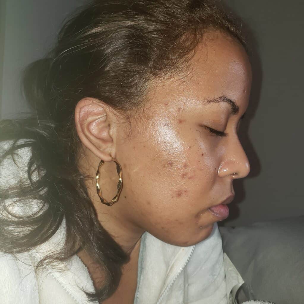 Profile view of cheek with dark spots and breakouts.