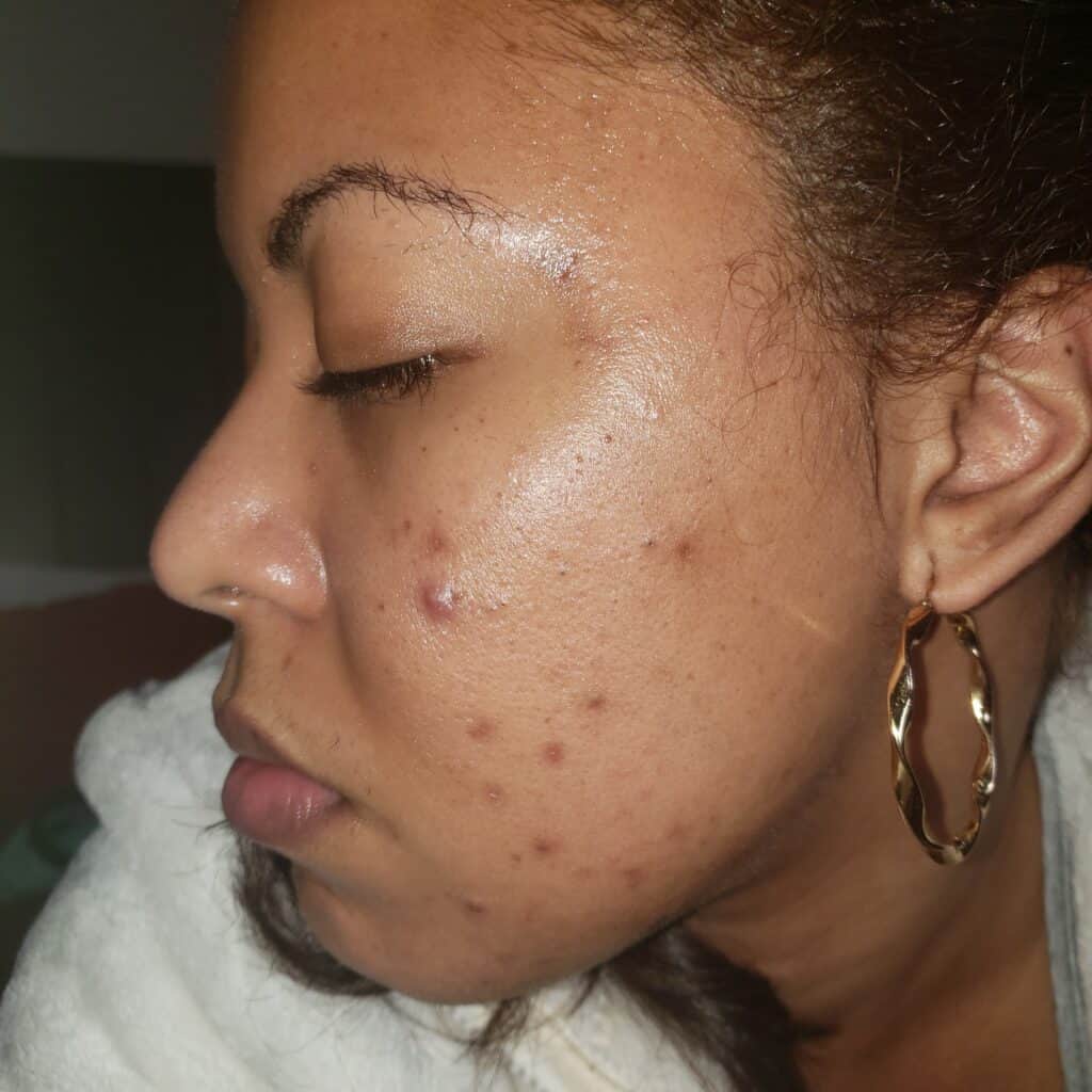 Cheek with visible acne scars and hyperpigmentation under natural light.