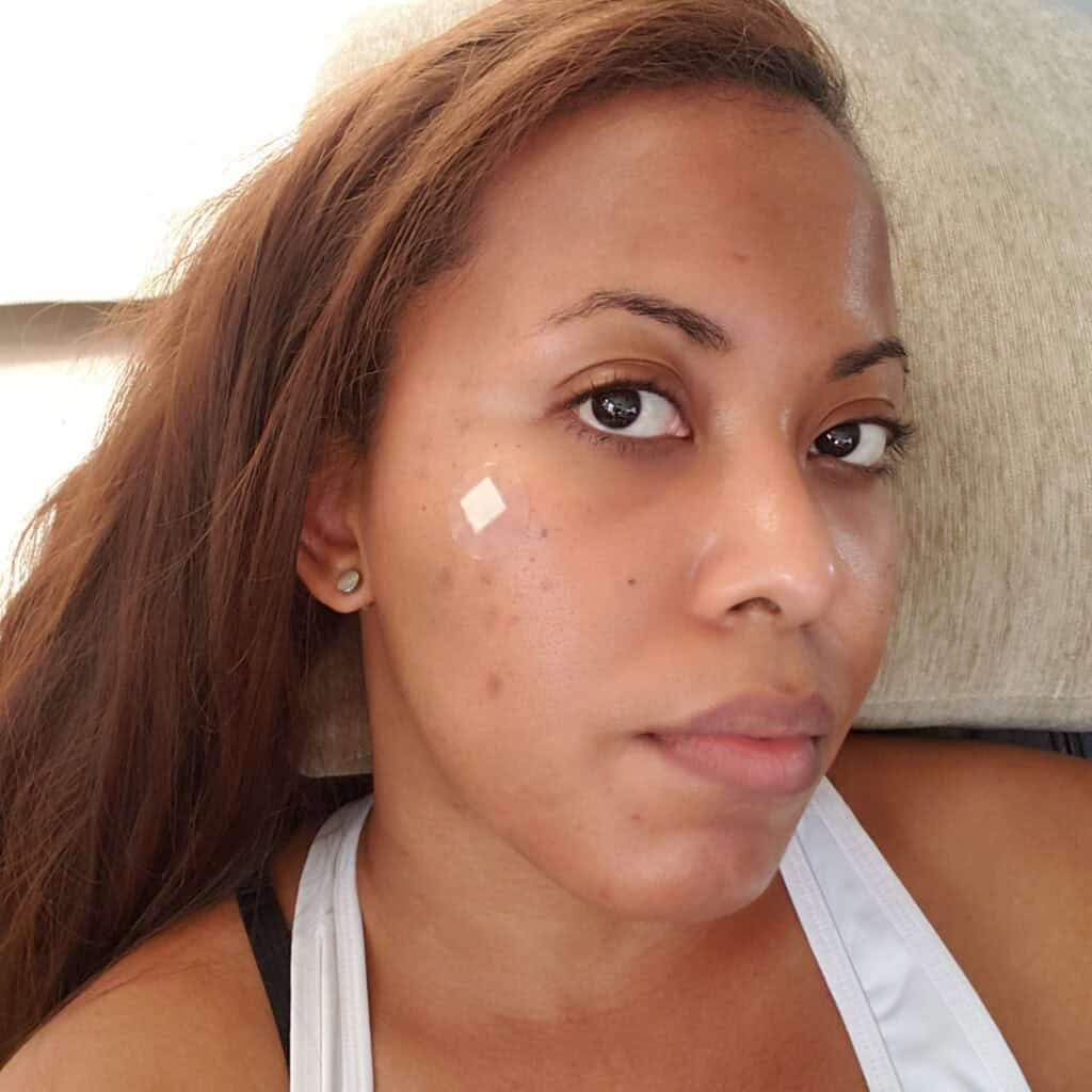 Front view of skin with acne scars and uneven tone before treatment.