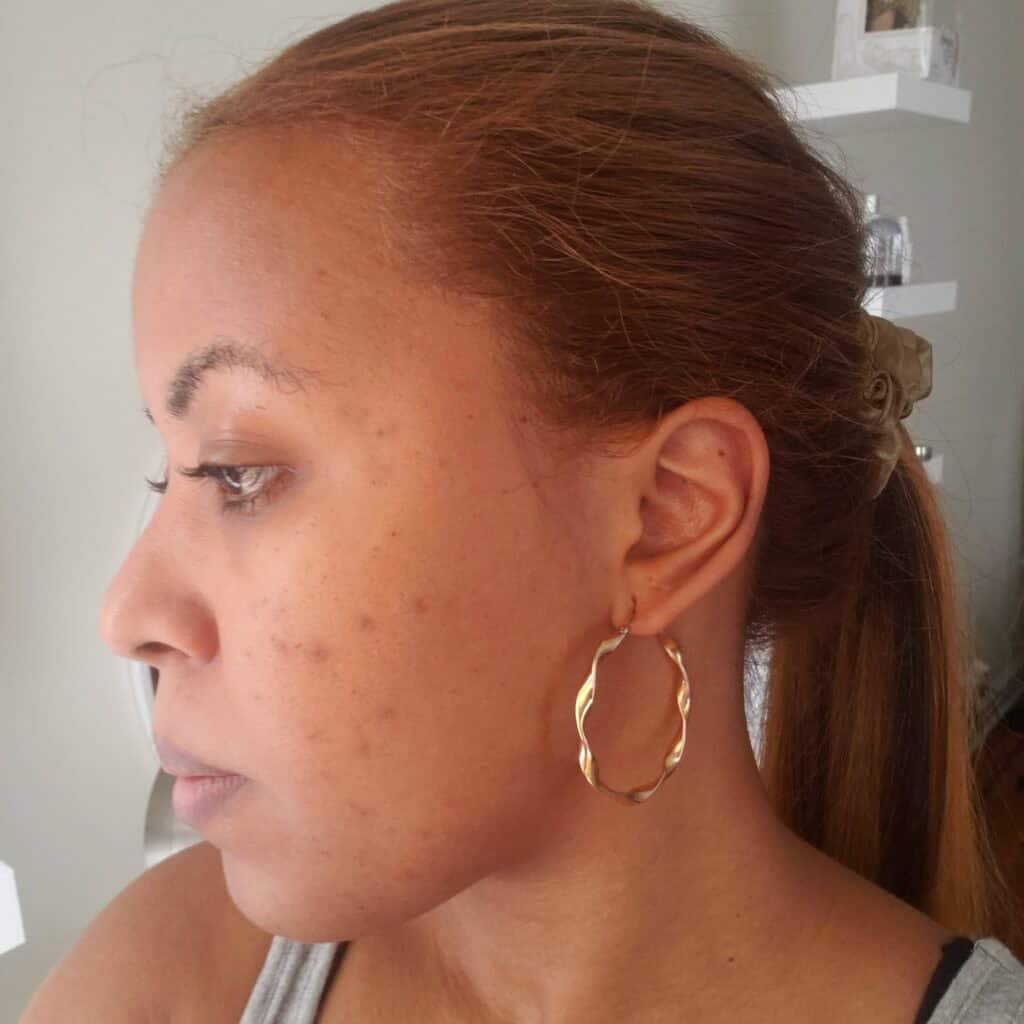 Skin with dark spots and uneven texture before HydraFacial treatment