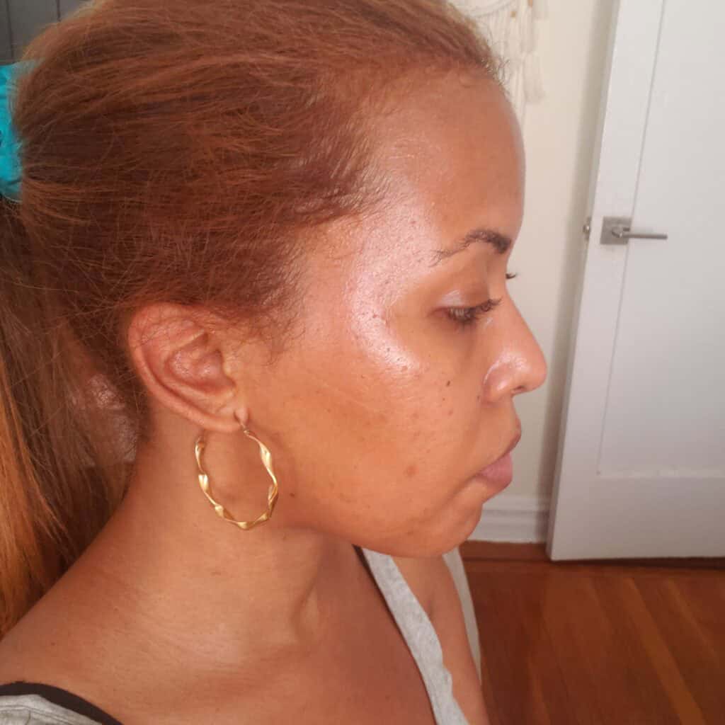 Skin after HydraFacial with Michael showing smoother texture and glow