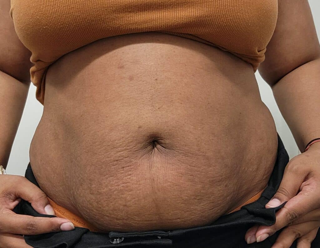Front view of stomach one year postpartum showing faded stretch marks and less discoloration.
