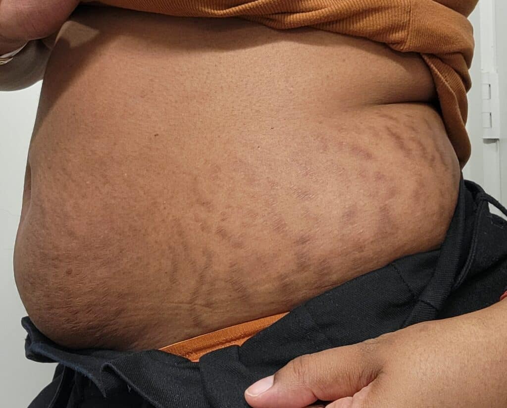 Left side of stomach one year after birth showing lighter stretch marks and smoother skin texture.