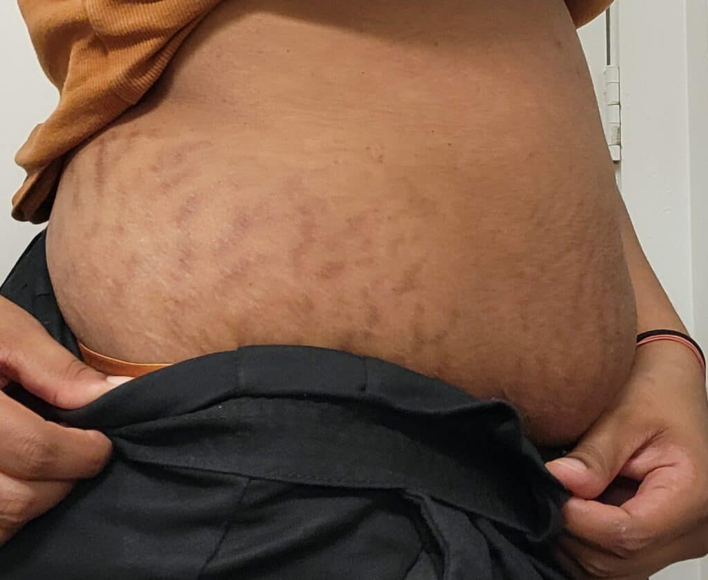 Right side of stomach one year postpartum with lighter, smoother stretch marks.
