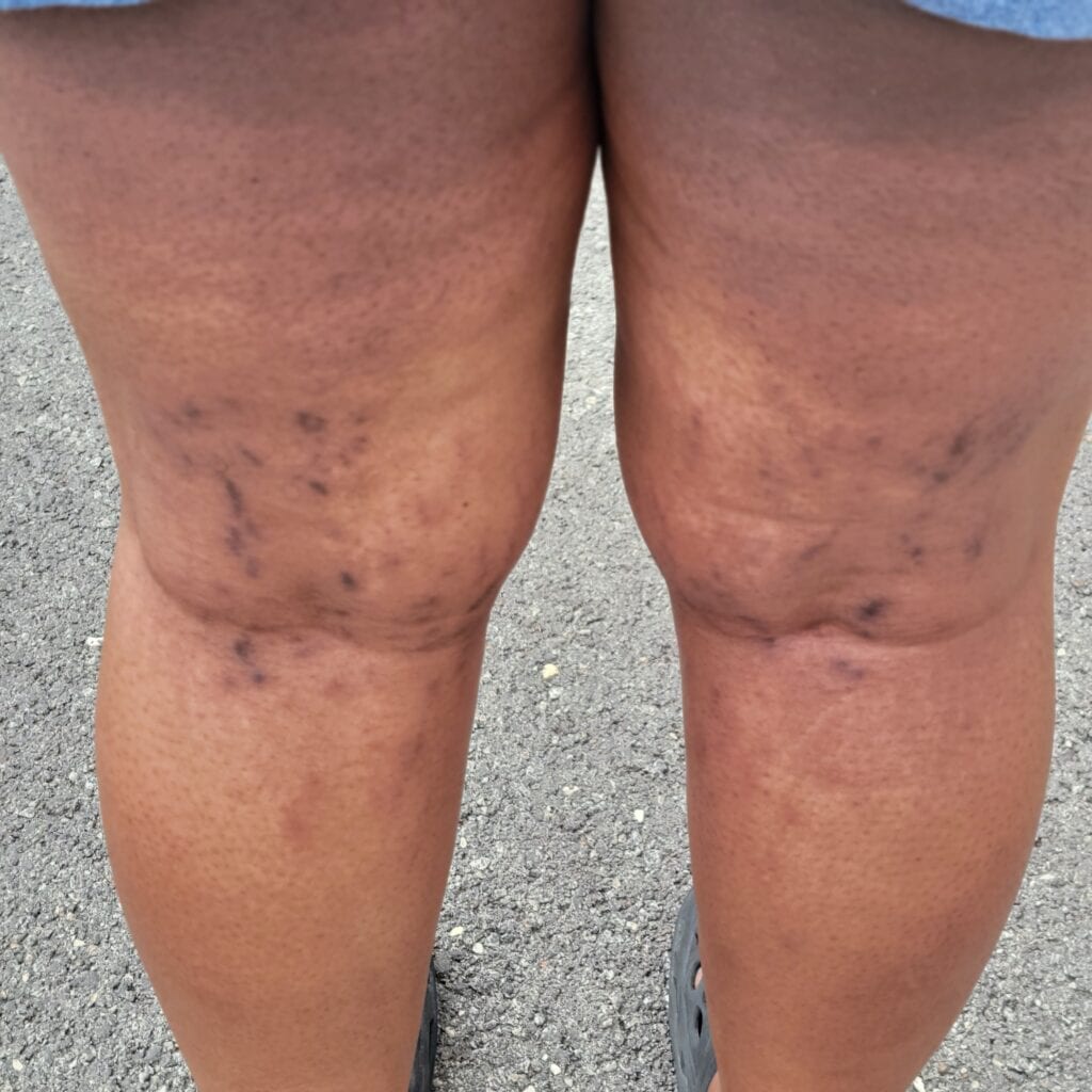 Hyperpigmented stretch marks and discoloration on the back of the legs during late pregnancy.