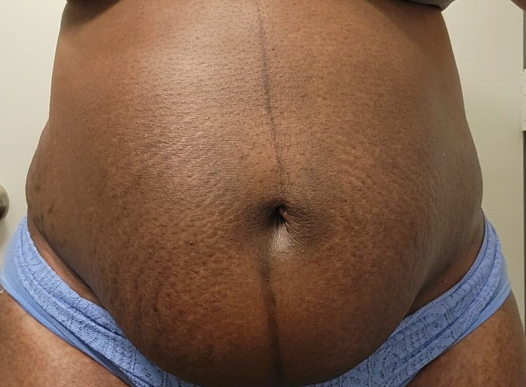 Front view of postpartum stomach two weeks after birth showing dark stretch marks and linea nigra.