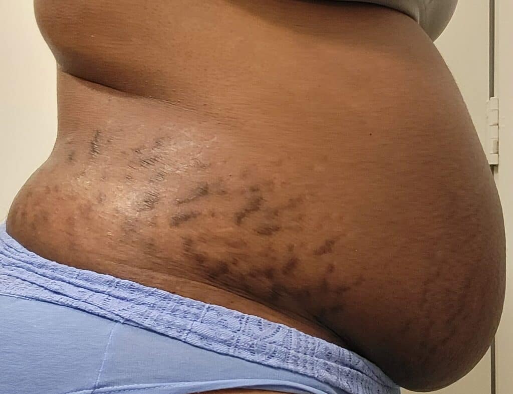 Right-side postpartum belly with dark, clustered stretch marks two weeks after birth.