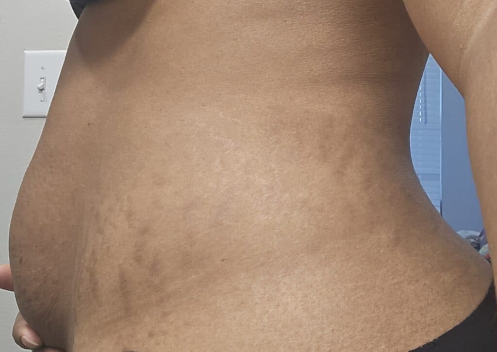 Left-side view with minimal stretch mark visibility two years postpartum.