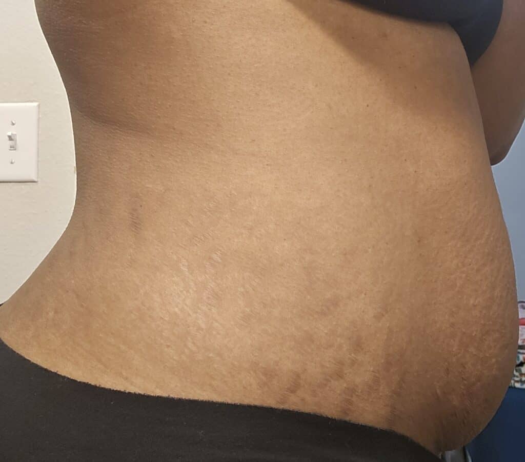 Right-side view two years postpartum showing very faint, smoothed stretch marks.