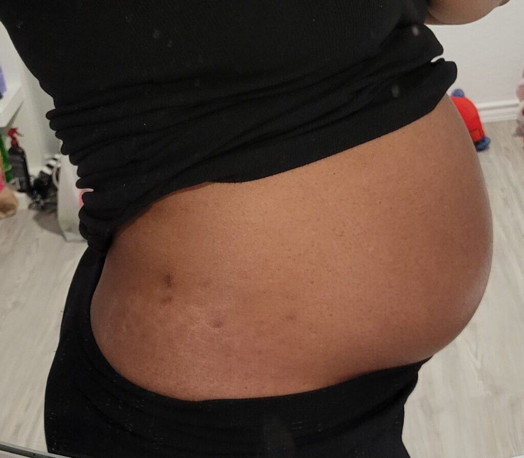24-week pregnant belly with early stretch marks forming on the lower stomach and sides.